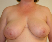 Feel Beautiful - Breast Reduction San Diego 16 - Before Photo